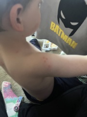 Chicken pox?