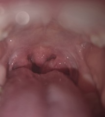 Tonsils picture please help!