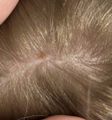 Scabies in nursery