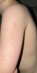 Dry bumpy toddler skin in winter? Help (pictures)