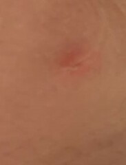 Chicken pox or bug bites?