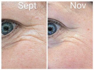 Tretinoin 0.006 - I think I can see an improvement already!! (Pic)