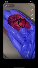 TW:MISCARRIAGE at 6 weeks *pictures*