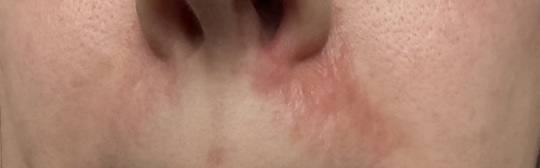Skin problem on face.. PLEASE help (pictures)