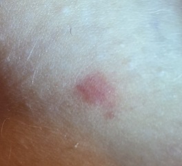Scabies?