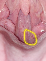 Growth on tonsil 2 week referral - help!