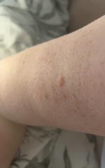 Is this a mole?