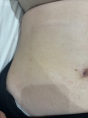 Help identify rash on teen please