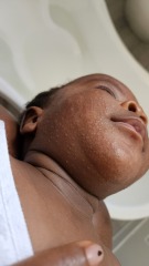 3 months old baby rash