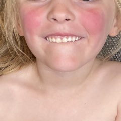 No Paediatric rheumatologists in our health board 😫