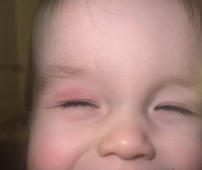 Anyone eczema experiences? Eyelid / pictures including