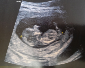 Guess the gender: boy or swollen girl.