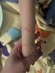Chicken pox?