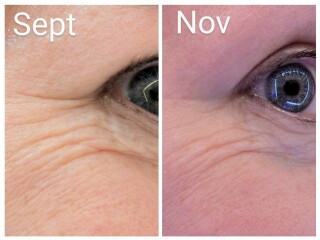 Tretinoin 0.006 - I think I can see an improvement already!! (Pic)