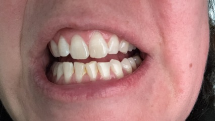 Health anxiety regarding teeth
