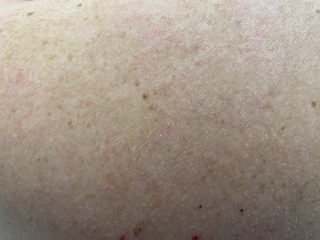 Rash on back