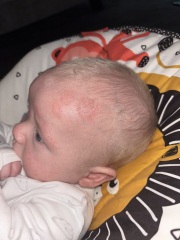 What is this on my sons head???