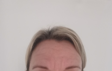 Will botex or anything help these forehead lines? ad