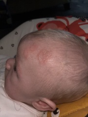 What is this on my sons head???