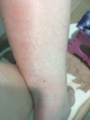 Chapped legs