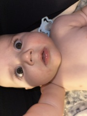 Rash - allergy? Ezcema? Or teething?