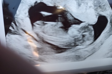 Baby scan gender