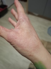 Hand infected (Warning, gross photos)