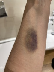 Excess bruising? Am I just a peach?