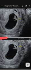 Possible mo-mo or mo-di twins after our embryo split