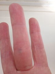 Painful vein suddenly appearing on fingers/hands
