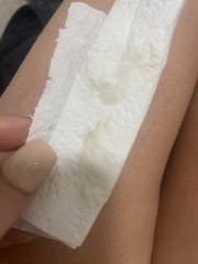 Implantation bleeding