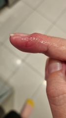 My finger is so sodding sore