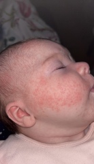 Neocate rash?