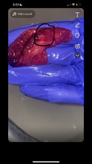 TW:MISCARRIAGE at 6 weeks *pictures*