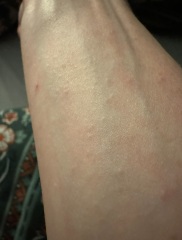 Any ideas on my rash?