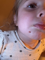 What is this on my daughters face