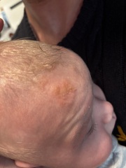 What is this on my sons head???