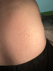 Sore rash/marks on back (photos)