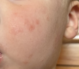 Recurring red marks on 2 year olds face