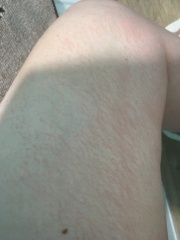 Chapped legs