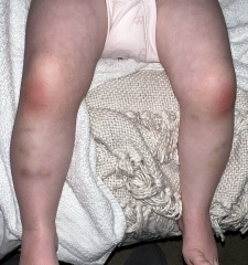 Are these normal toddler bruises on legs?