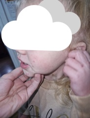 Chicken pox? Hand foot and mouth?