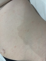 Help identify rash on teen please