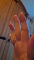 Both ring fingers are crooked.