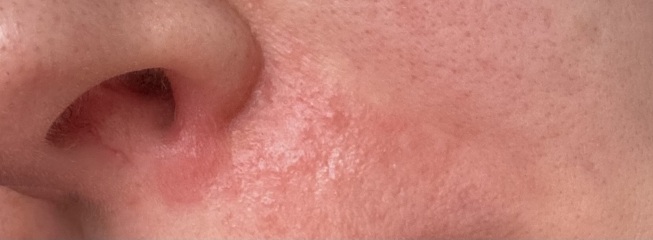 Skin problem on face.. PLEASE help (pictures)