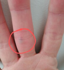 Painful vein suddenly appearing on fingers/hands