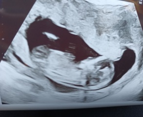 Baby scan gender