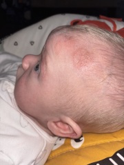 What is this on my sons head???