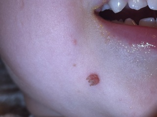 What is this on my daughters face