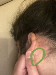 Small bump behind ear
